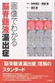 画像でわかる脳脊髄液漏出症